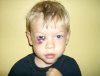 black+eye+day+2.jpg