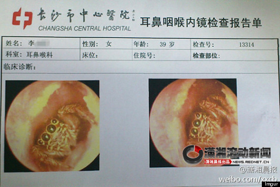o-SPIDER-IN-EAR-CANAL-570.jpg